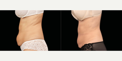 Emsculpt before and after photo
