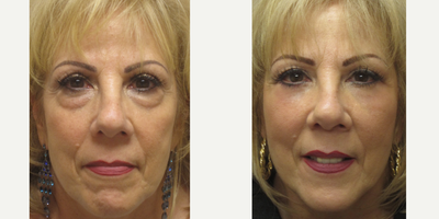 Eyelid Surgery before and after photo