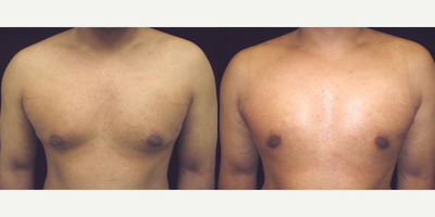 Gynecomastia Surgery before and after photo