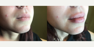 Lip Fillers before and after photo
