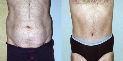 Male Tummy Tuck before and after photo