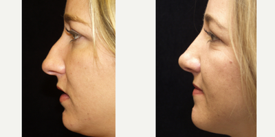 Rhinoplasty before and after photo