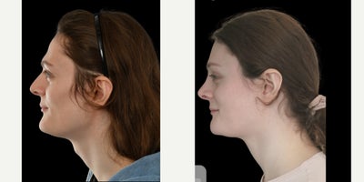 Brow Lift before and after photo