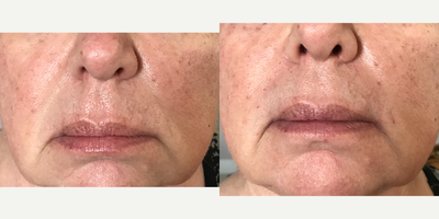 Dermal Fillers before and after photo