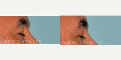 Double Eyelid Surgery before and after photo