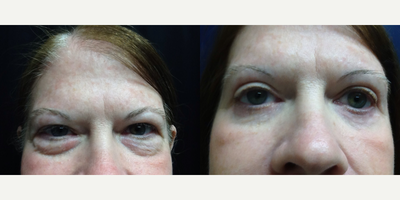 Eyelid Surgery before and after photo