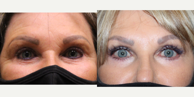 Eyelid Surgery before and after photo