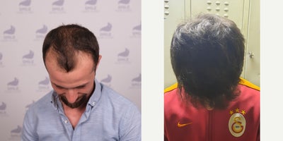 Hair Loss Treatment before and after photo