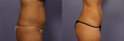 Liposuction before and after photo