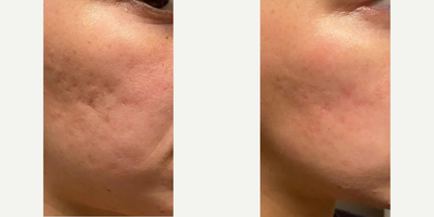 Microneedling before and after photo