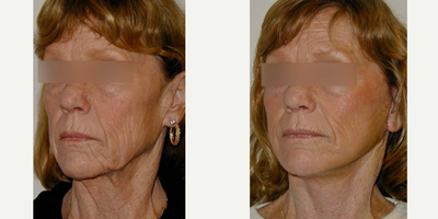 Mini Facelift before and after photo