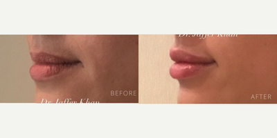 Lip Fillers before and after photo