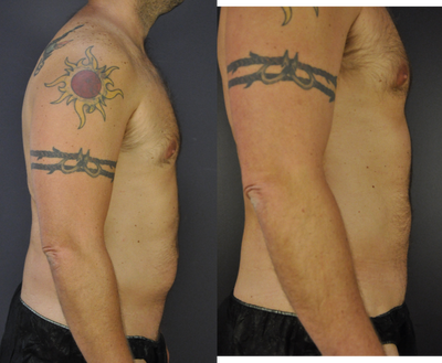 Liposuction before and after photo