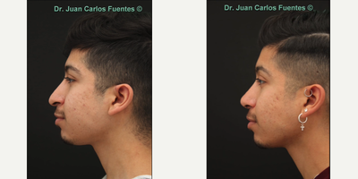 Rhinoplasty before and after photo