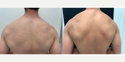 Accutane before and after photo