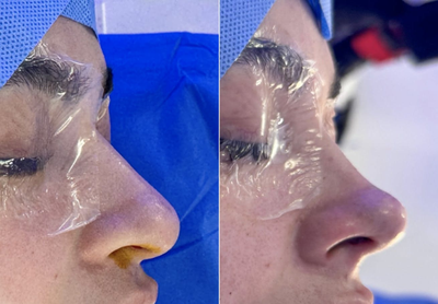 Alarplasty before and after photo