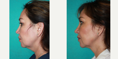 Kybella before and after photo