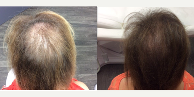PRP for Hair Loss before and after photo
