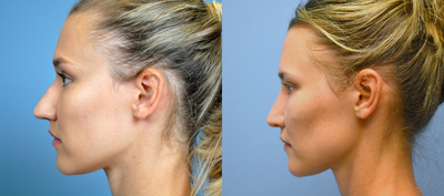 Rhinoplasty before and after photo