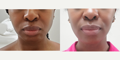 Botox for TMJ before and after photo