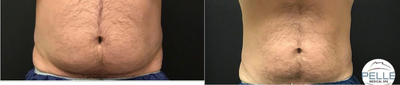 CoolSculpting before and after photo