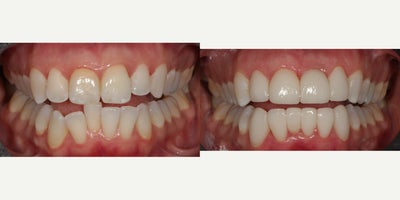 Dental Implants before and after photo