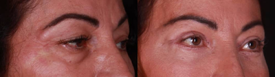 Eyelid Surgery before and after photo