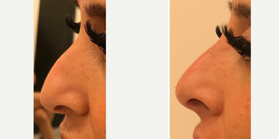 Nonsurgical Nose Job before and after photo