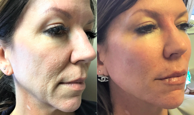 Botox before and after photo