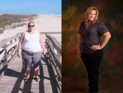 Gastric Sleeve Surgery before and after photo