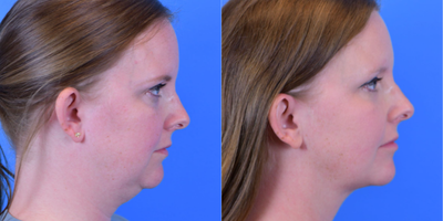 Nonsurgical Facelift before and after photo
