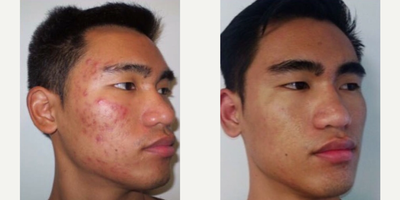 Photodynamic Therapy before and after photo