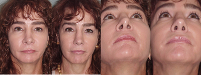 Revision Rhinoplasty before and after photo