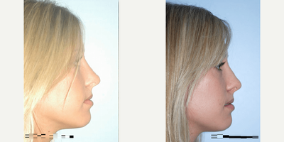 Rhinoplasty before and after photo