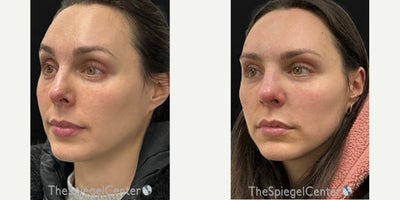 Xeomin before and after photo