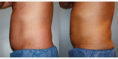 CoolSculpting before and after photo