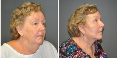 Facelift before and after photo
