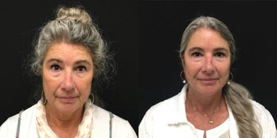 Facelift before and after photo