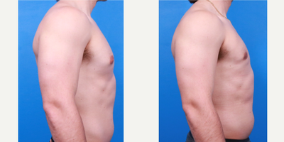 Gynecomastia Surgery before and after photo