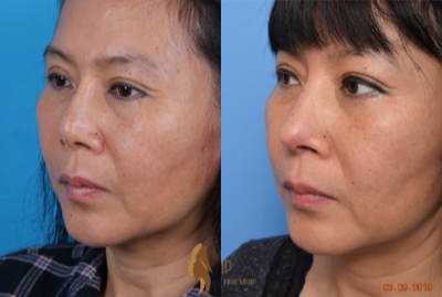 Rhinoplasty before and after photo