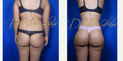 Butt Implants before and after photo