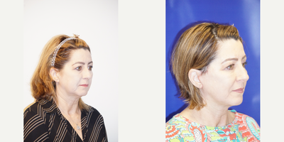 Deep Plane Facelift before and after photo