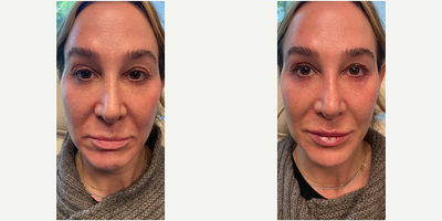 Dermal Fillers before and after photo