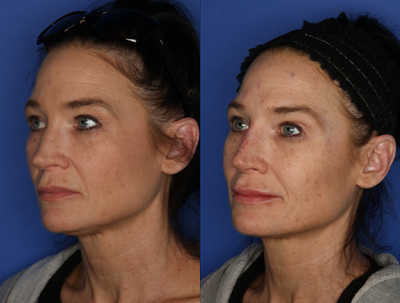 Restylane before and after photo