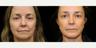 Eyelid Surgery before and after photo