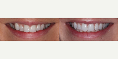 Invisalign before and after photo