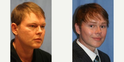Neck Lift before and after photo