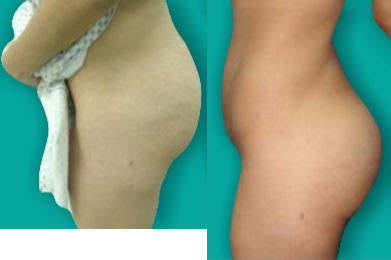 Brazilian Butt Lift before and after photo