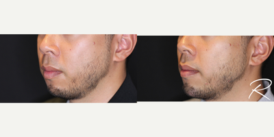Juvederm before and after photo