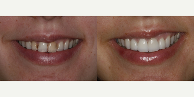 Porcelain Veneers before and after photo